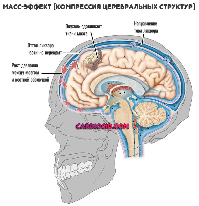Атрофия коры головного мозга (Болезнь Пика) - симптомы, лечение